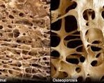 What osteoporosis looks like. 