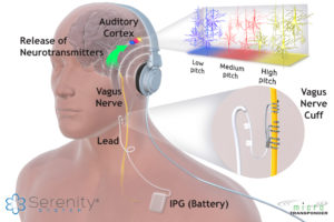 Serenity-System-Tinnitus